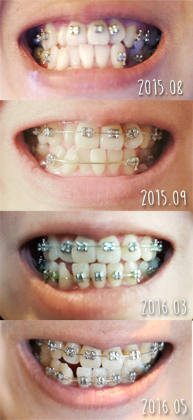 before after2